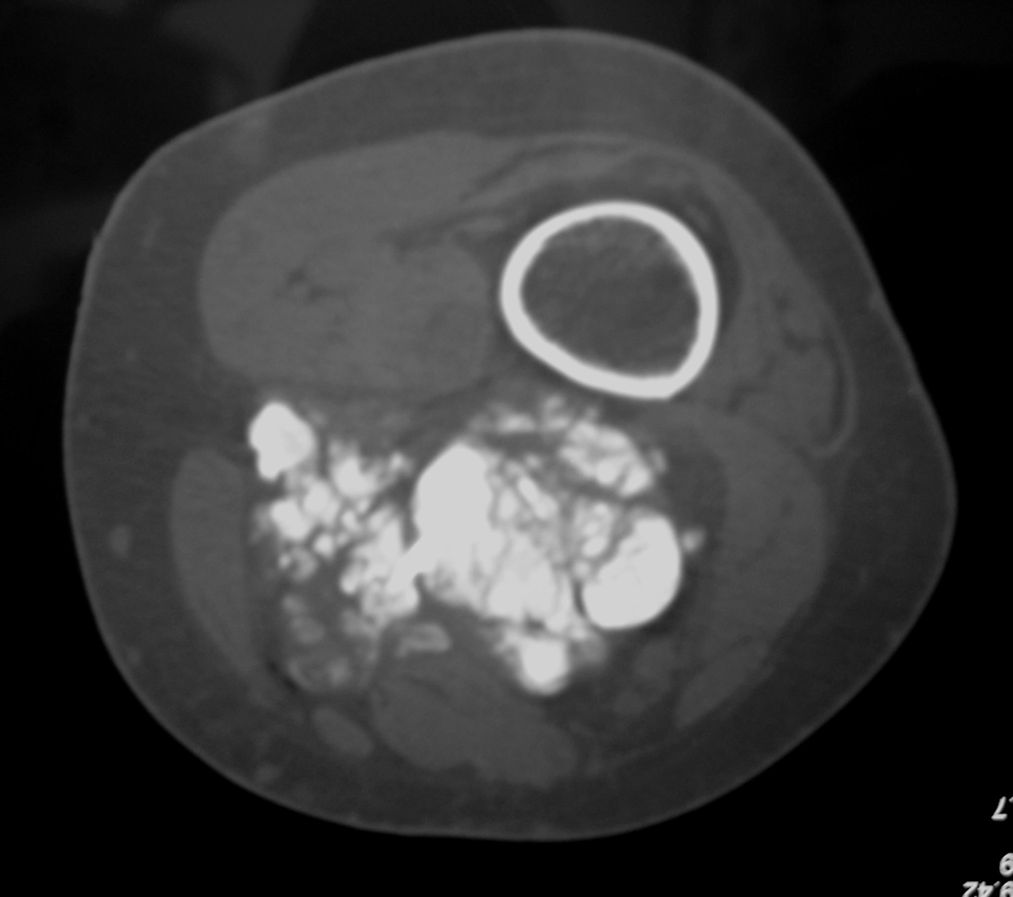 extraskeletal-osteosarcoma-soft-tissue-osteosarcoma